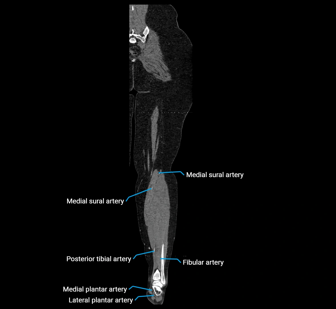 CTA lower limb coronal cross sectional anatomy labelled image _73 (2).webp